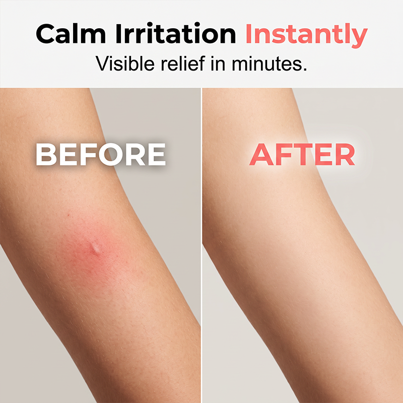 🔥Hot Sale 50% OFF🔥 Stop Scratching in 10 Sec! Portable Bug Bite Relief Pen – Heat Pulse, No Cream, No Mess 🦟